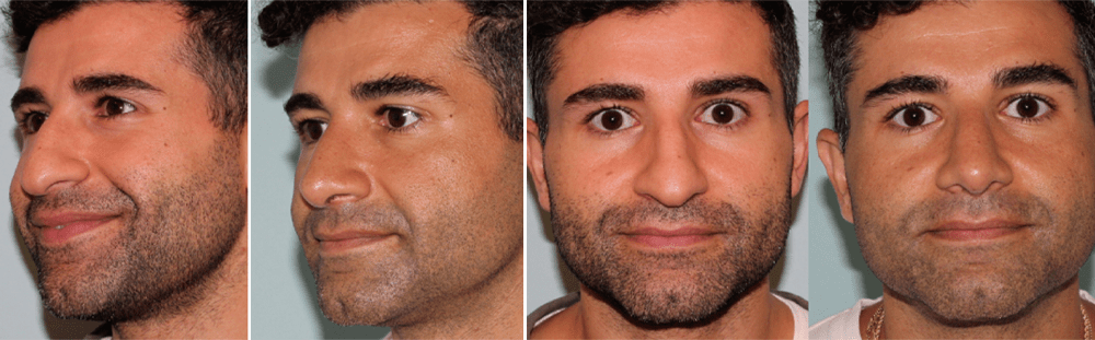Rhinoplasty-3