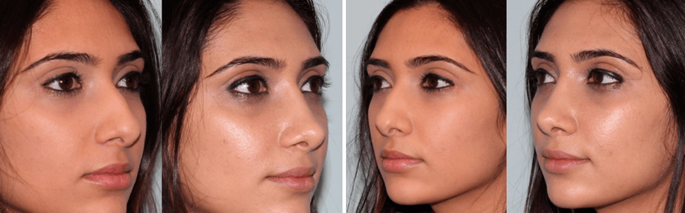 Rhinoplasty-4