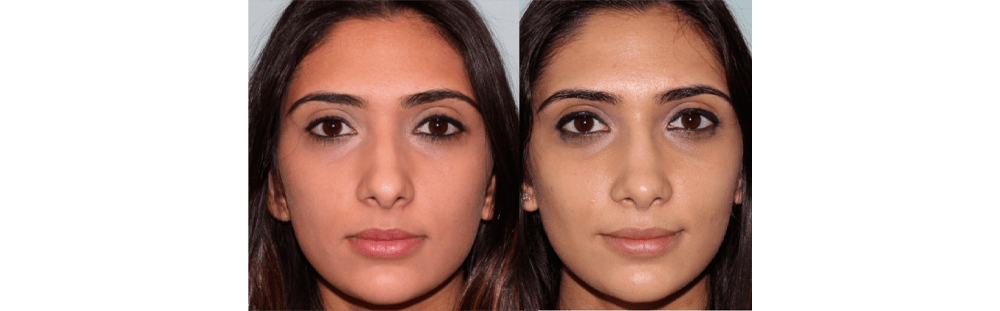 Rhinoplasty-5