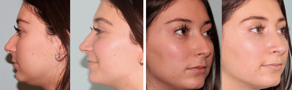 Rhinoplasty-6