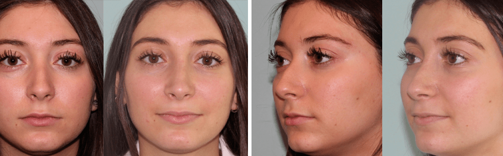 Rhinoplasty-7