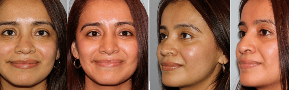 Rhinoplasty-8