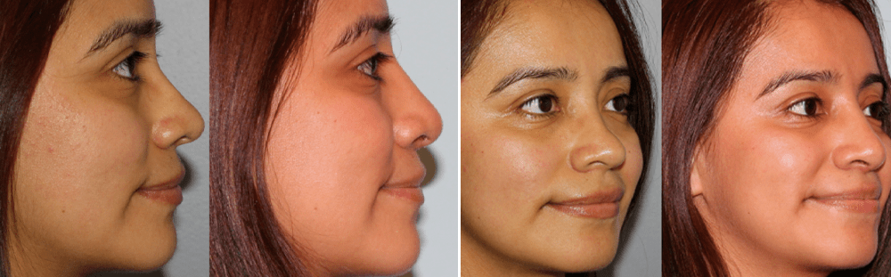 Rhinoplasty-9