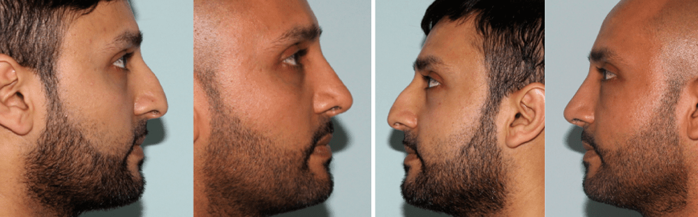 Rhinoplasty-10
