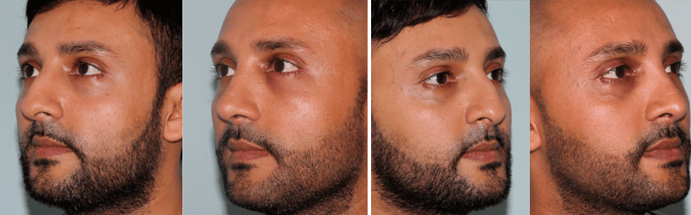 Rhinoplasty-11