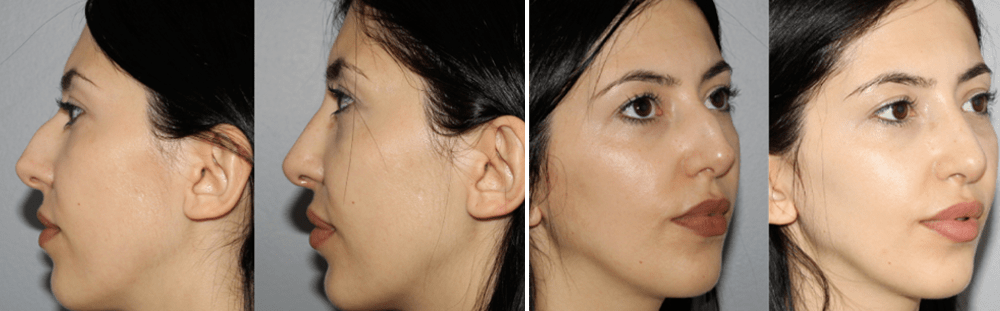 Rhinoplasty-12