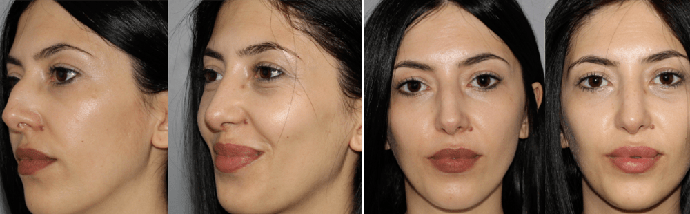 Rhinoplasty-13