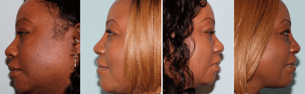 Rhinoplasty-14