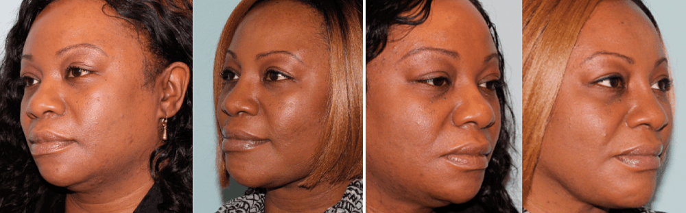 Rhinoplasty-15