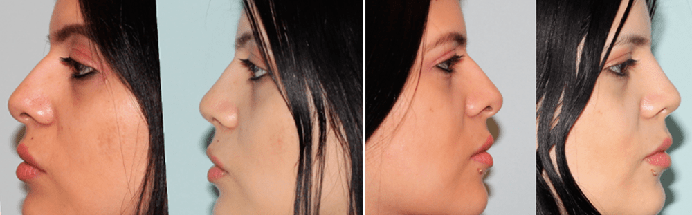 Rhinoplasty-16