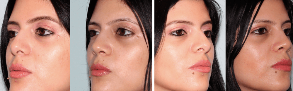 Rhinoplasty-17