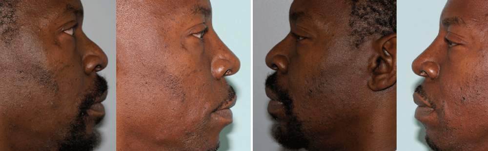 Rhinoplasty-18