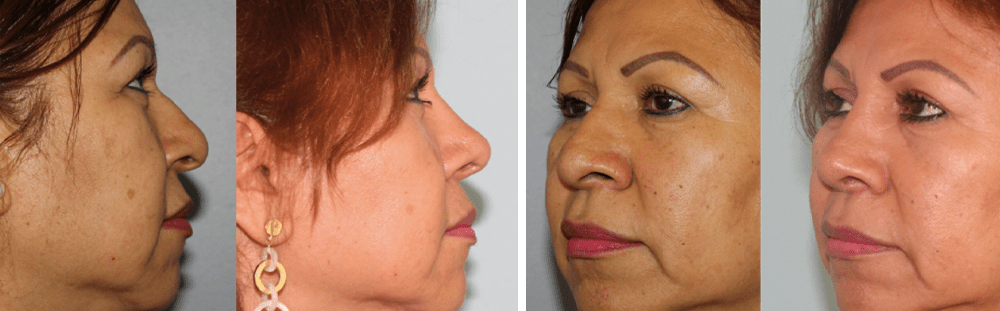Rhinoplasty-20