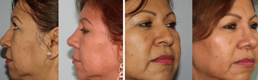 Rhinoplasty-21