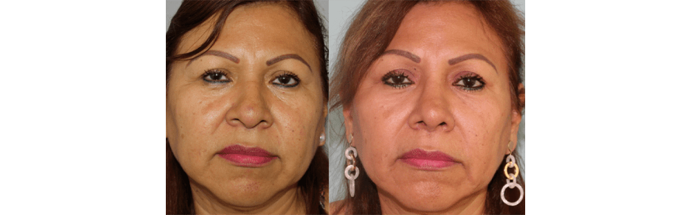 Rhinoplasty-22