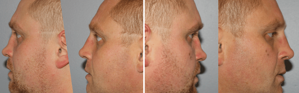 Rhinoplasty-23