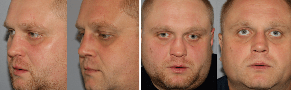 Rhinoplasty-24