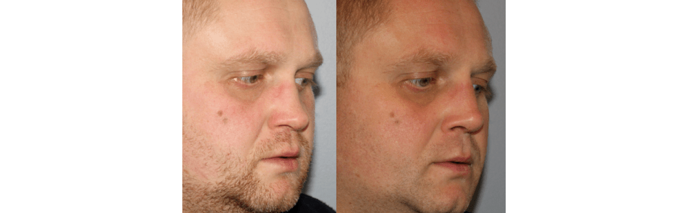 Rhinoplasty-25