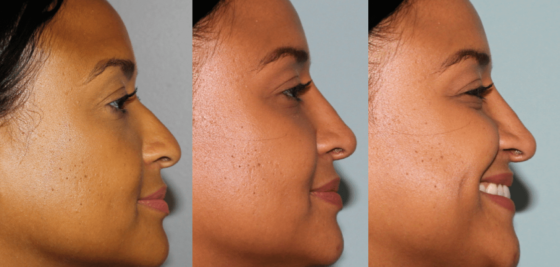 Rhinoplasty-26