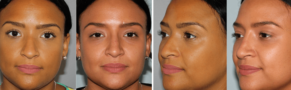 Rhinoplasty-27