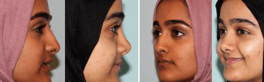 Rhinoplasty-28