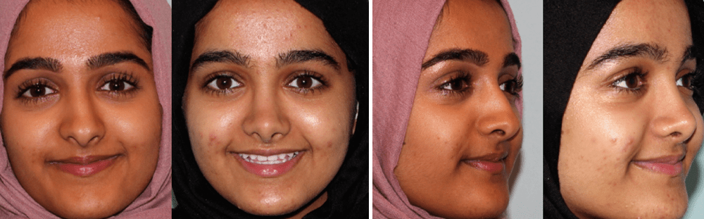 Rhinoplasty-29