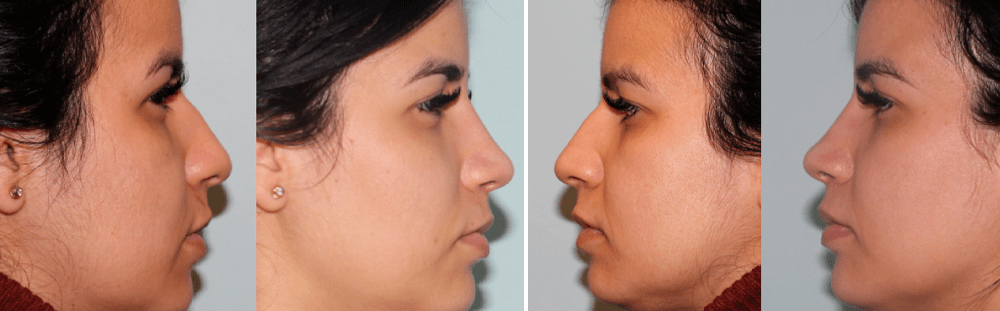 Rhinoplasty-30