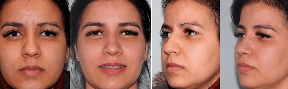 Rhinoplasty-31