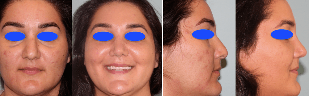 Rhinoplasty-33