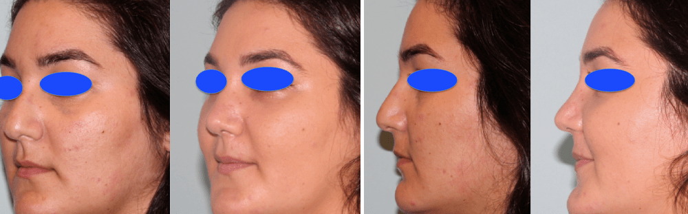 Rhinoplasty-34