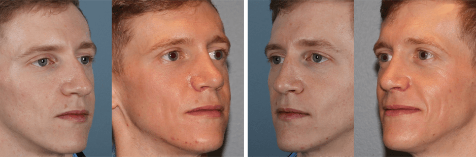 Open Rhinoplasty