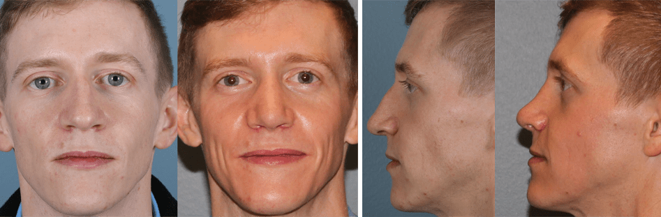 Open Rhinoplasty