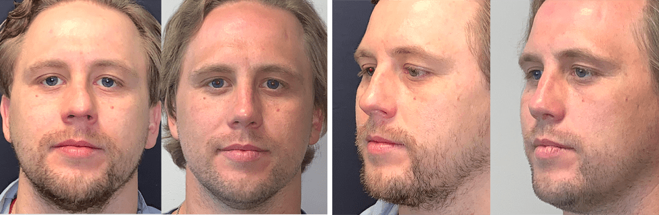Open Rhinoplasty