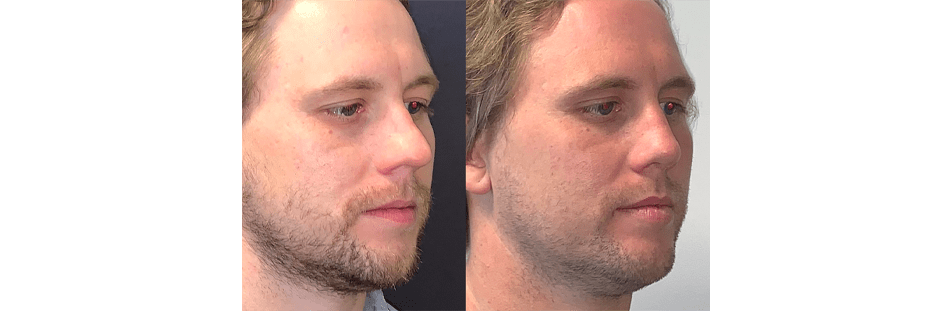 Open Rhinoplasty