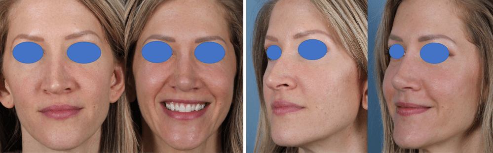 Open Rhinoplasty