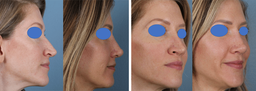 Open Rhinoplasty