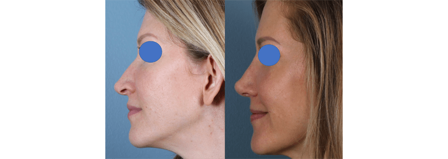 Open Rhinoplasty
