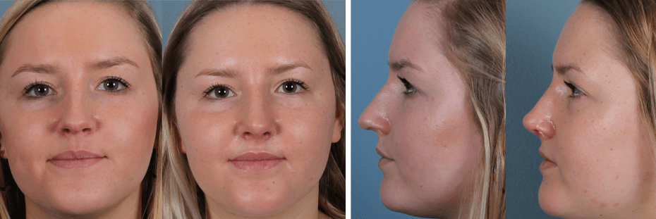 Endonasal (Closed) Rhinoplasty