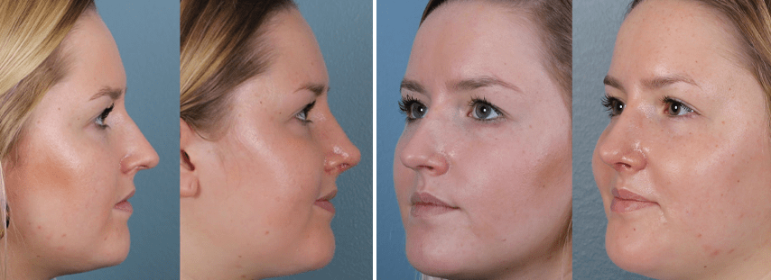 Endonasal (Closed) Rhinoplasty