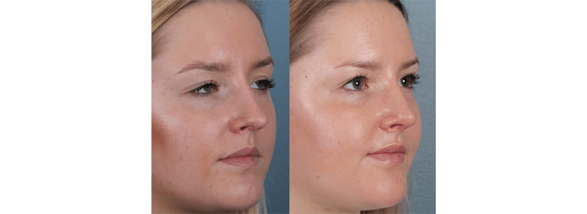 Endonasal (Closed) Rhinoplasty