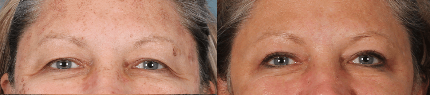 Upper Blepharoplasty