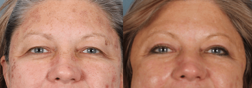 Upper Blepharoplasty