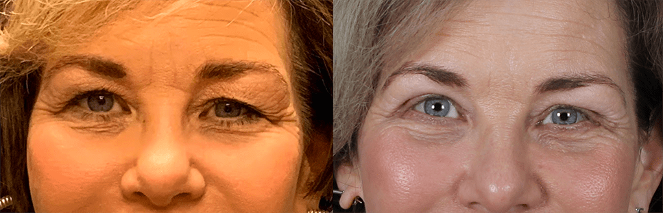 Upper and Lower Blepharoplasty