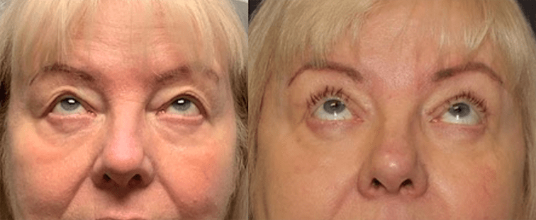 Upper Blepharoplasty