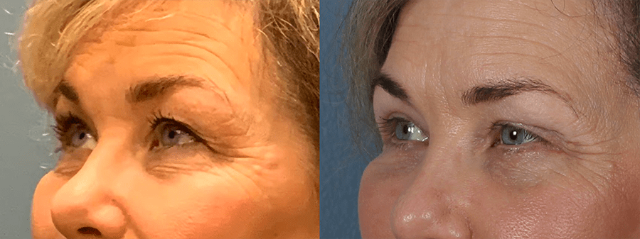 Upper and Lower Blepharoplasty