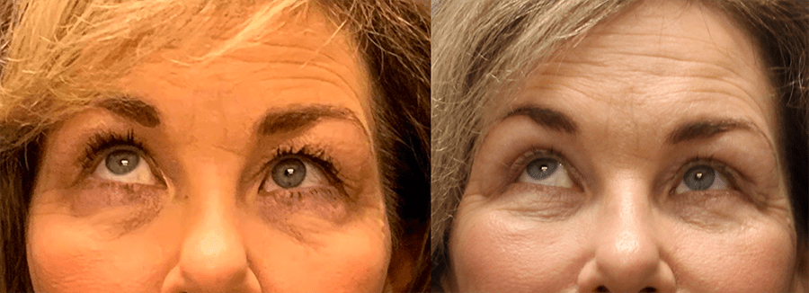 Upper and Lower Blepharoplasty