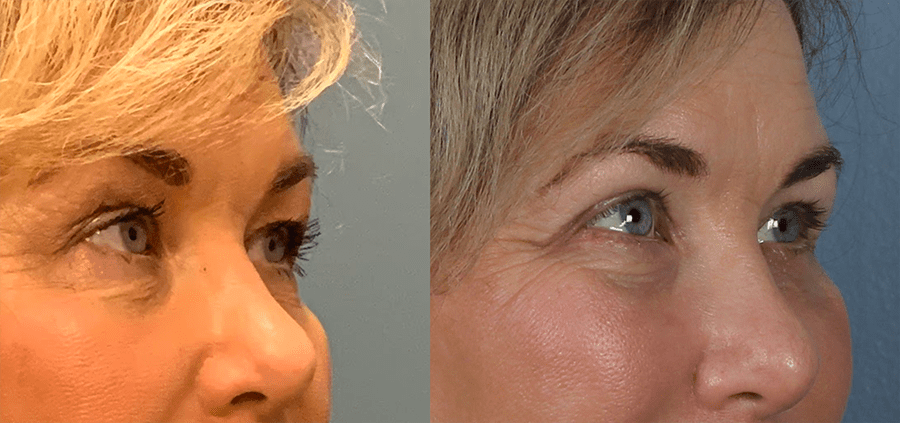 Upper and Lower Blepharoplasty