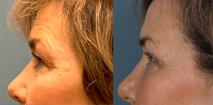 Upper and Lower Blepharoplasty