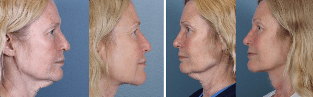 Midline facelift and scar revision