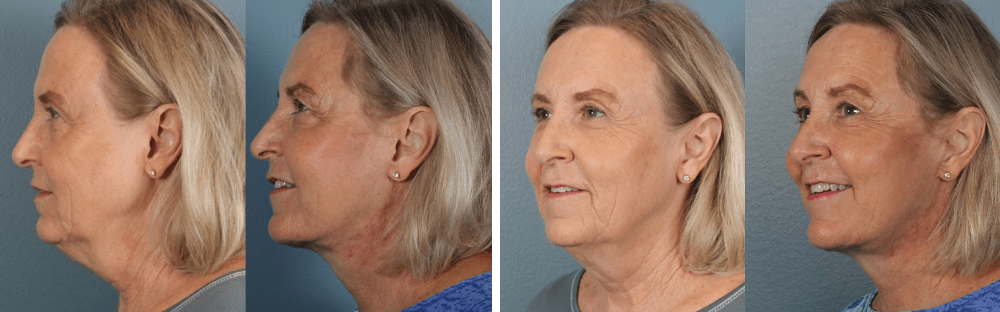 Deep plane facelift